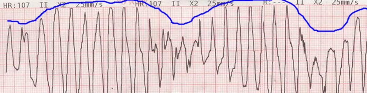 Hypomagnesemia – Monitor ECG: torsade de pointes – polymorphic ventricular tachycardia with QRS axis twisting around the baseline