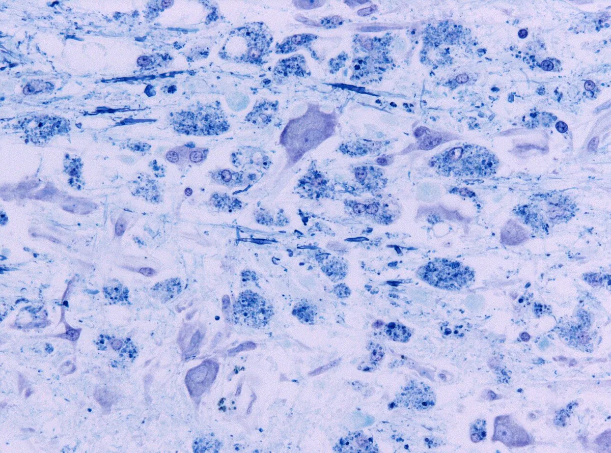 Hyponatremia – histology: Osmotic demyelination, high power: macrophages containing ingested myelin (myelinophages) in demyelinated tissue