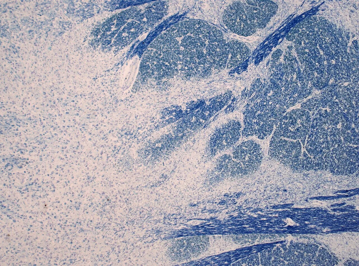 Hyponatremia – Histology of the pons (myelin stain) in osmotic demyelination: pale demyelinated central areas between intact blue-stained myelinated fibers