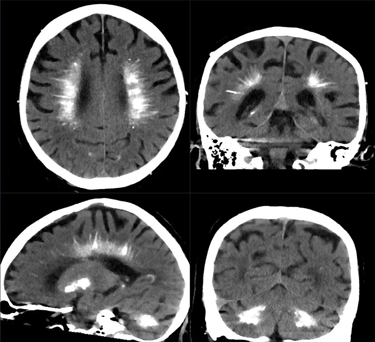 Hypoparathyroidism – Head CT: symmetric calcifications of the basal ganglia, white matter and cerebellar nuclei – a pattern that occurs in long-standing hypoparathyroidism