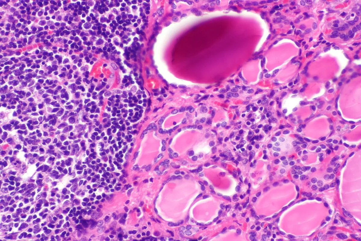 Hypothyroidism – Histology of Hashimoto's thyroiditis as the most common cause (H&E, high power): dense lymphocytic infiltrate (left) next to small, compressed thyroid follicles