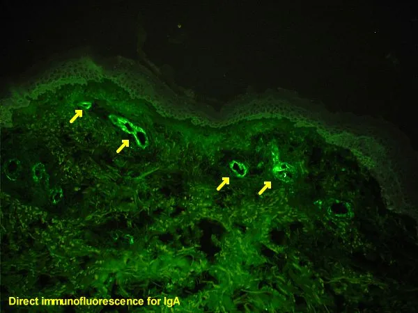 IgA-Vaskulitis (Purpura Schönlein-Henoch) – Direkte Immunfluoreszenz einer Hautbiopsie: IgA-Ablagerungen in den Wänden kleiner dermaler Gefäße (Pfeile)