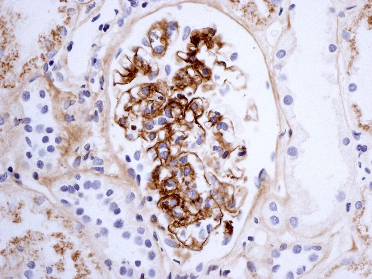 IgA-Vaskulitis (Purpura Schönlein-Henoch) – Histologie: Nierenbiopsie, Immunhistochemie für IgA: glomeruläre IgA-Ablagerungen (mesangial und entlang der Kapillarschlingen) bei IgA-Vaskulitis-Nephritis