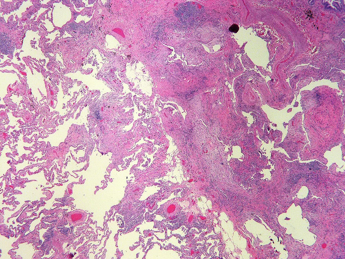 Idiopathic pulmonary fibrosis and interstitial lung disease – Histology (H&E): usual interstitial pneumonia (UIP) – patchy juxtaposition of normal alveoli, fibrosis and inflammation