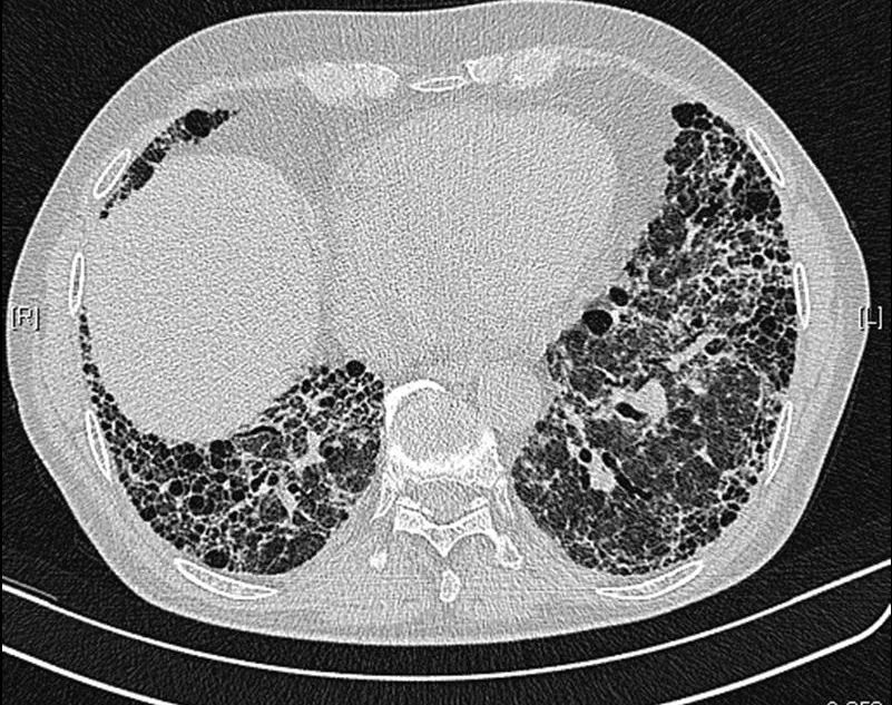 Idiopathic pulmonary fibrosis and interstitial lung disease – CT scan: HRCT in idiopathic pulmonary fibrosis: subpleural, basal-predominant reticulation with honeycombing and traction bronchiectasis (UIP pattern)
