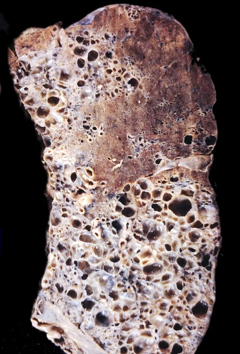 Idiopathic pulmonary fibrosis and interstitial lung disease – Gross specimen: honeycomb lung with numerous cystic spaces separated by dense fibrous bands, basal-predominant