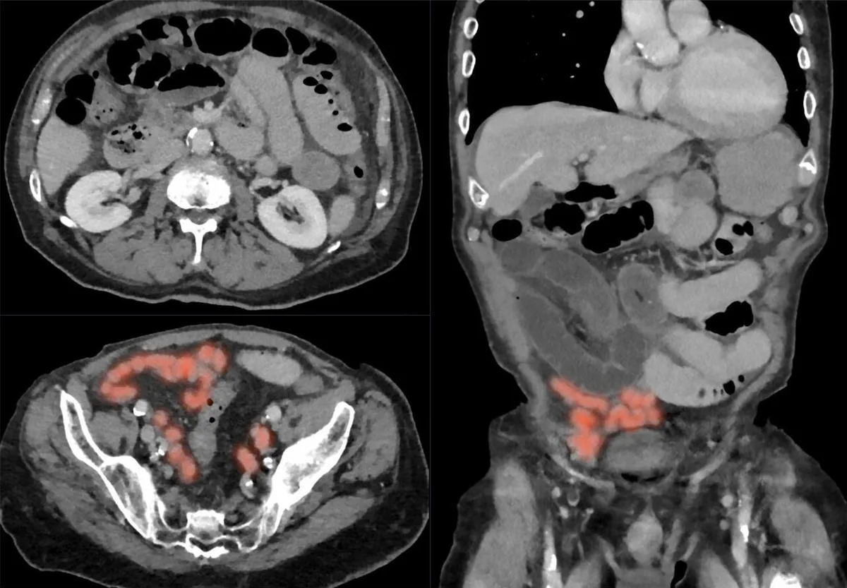 Bowel obstruction (ileus) – CT axial and coronal: fluid-filled dilated small-bowel loops with collapsed distal bowel (highlighted in red) in adhesive small-bowel obstruction