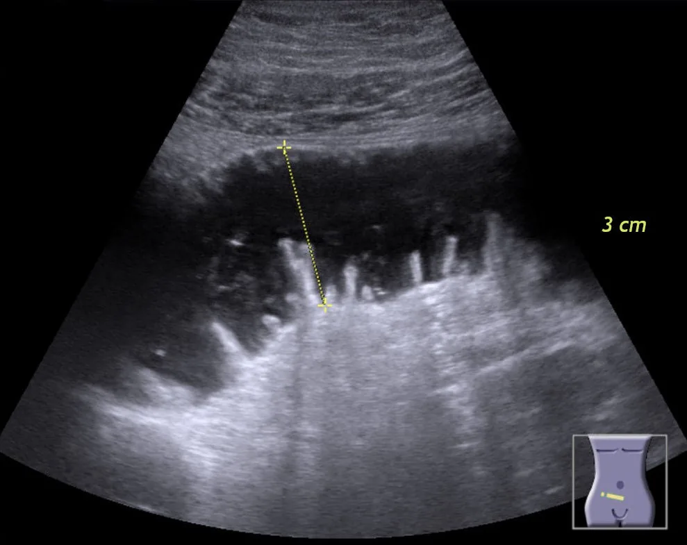 Bowel obstruction (ileus) – Ultrasound: fluid-filled dilated small-bowel loop with prominent valvulae conniventes ('keyboard sign') in bowel obstruction
