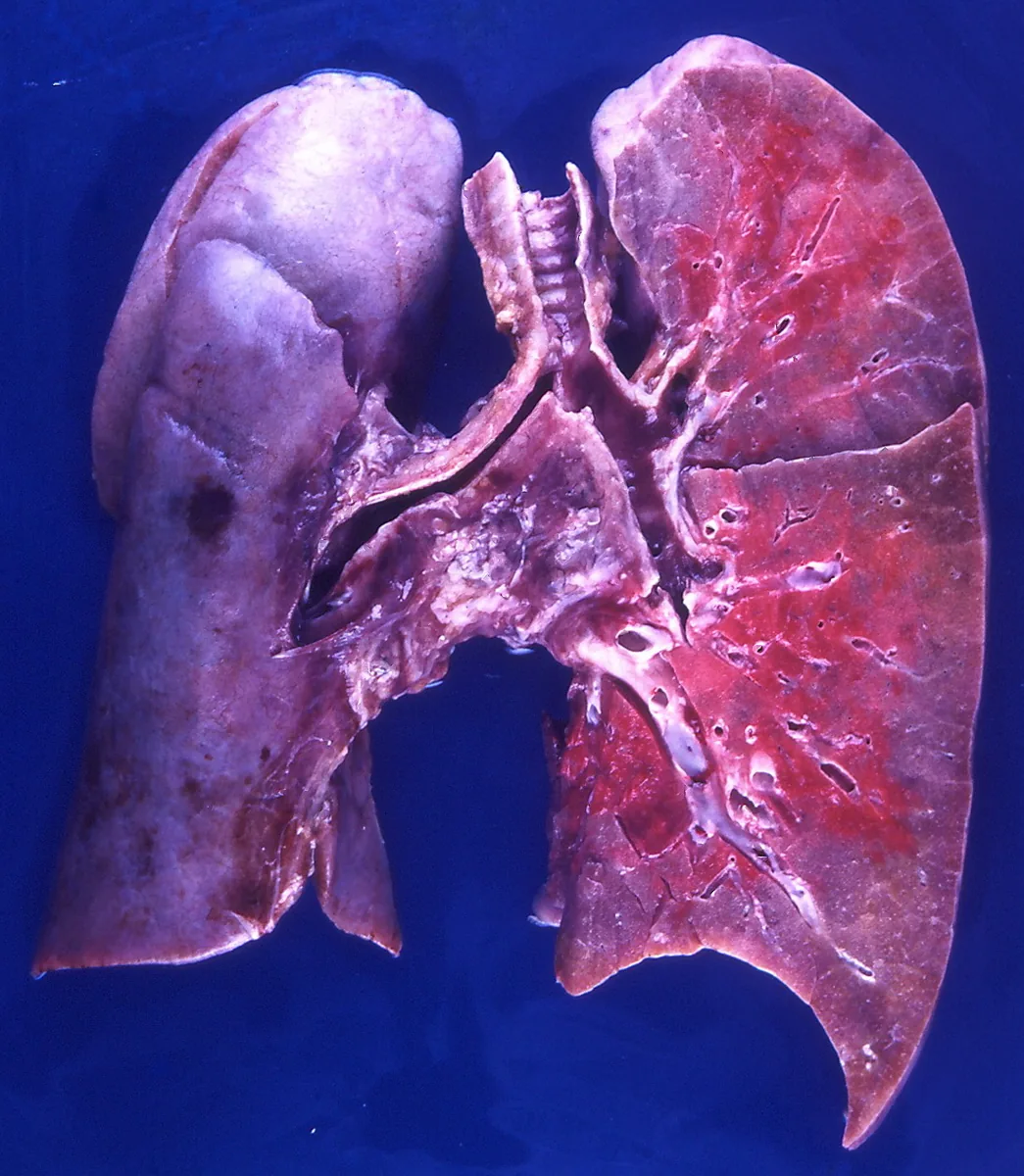 Influenza (flu) – gross specimen: Autopsy specimen in influenza pneumonia: heavy, dark red, hemorrhagic and congested lung