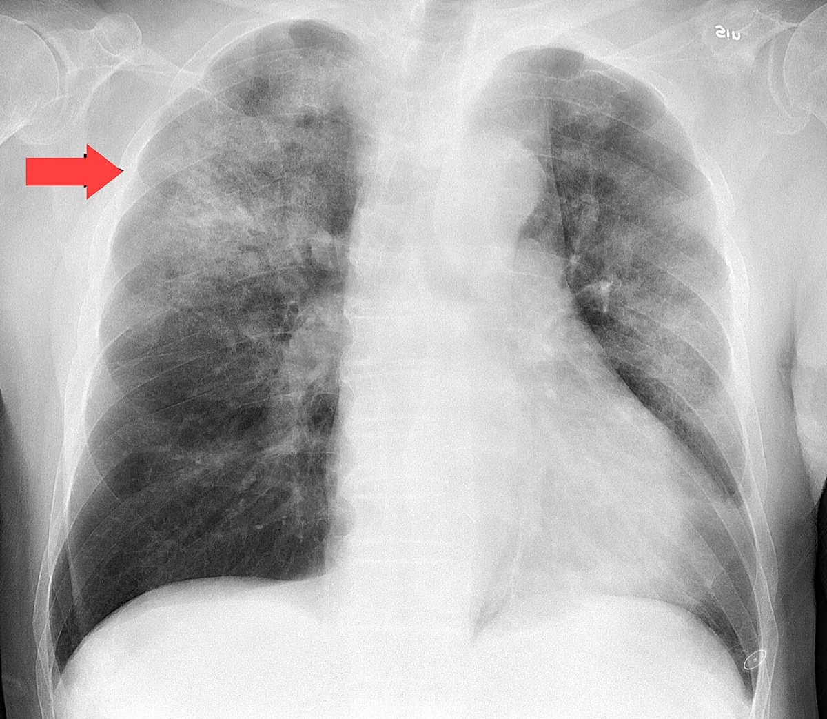 Influenza (flu) – X-ray: Chest X-ray in influenza A infection with bacterial co-infection (Hemophilus influenzae): patchy opacity in the right upper zone (arrow)