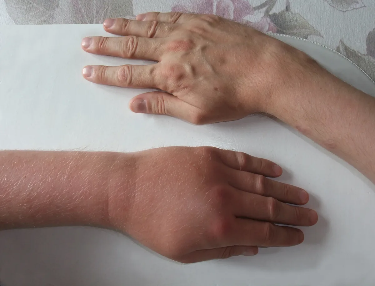 Insect venom allergy – clinical photo: Large local reaction after a wasp sting: markedly swollen back of the hand compared with the unaffected side