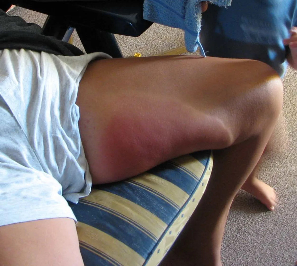 Insect venom allergy – leg – clinical photo: Extensive redness and swelling of the thigh after a wasp sting