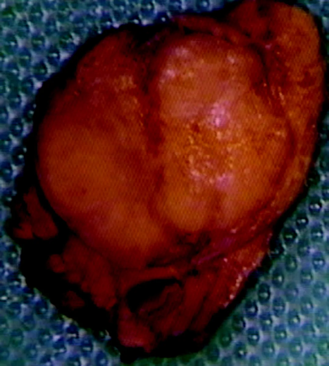 Insulinoma – gross specimen: Gross appearance of an insulinoma: well-circumscribed, reddish-brown, round pancreatic tumor
