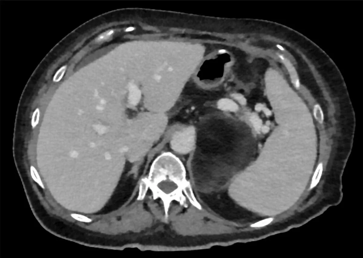 Adrenal incidentaloma – Axial CT: large left adrenal mass with fat-density components (myelolipoma)