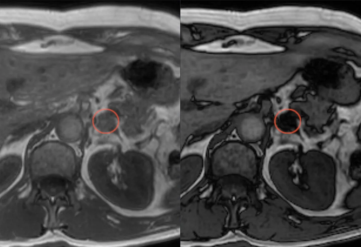 Adrenal incidentaloma – MRI T1 in/opposed phase: adrenal nodule (circle) with clear signal drop on opposed phase, indicating a lipid-rich adenoma