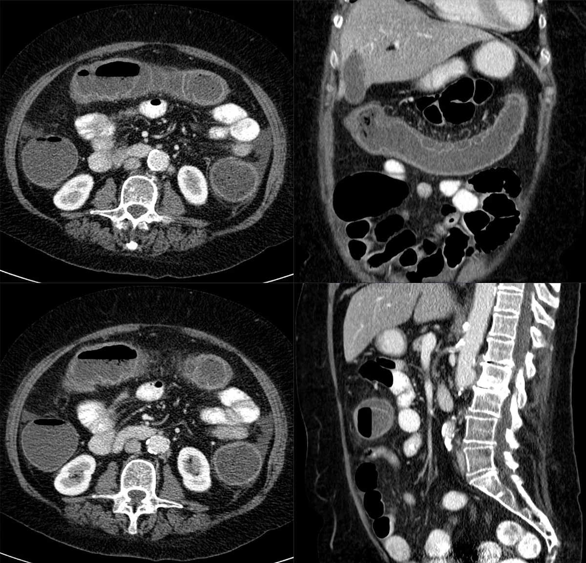 Ischemic colitis – CT axial, coronal and sagittal: edematous wall thickening of the transverse colon in ischemic colitis