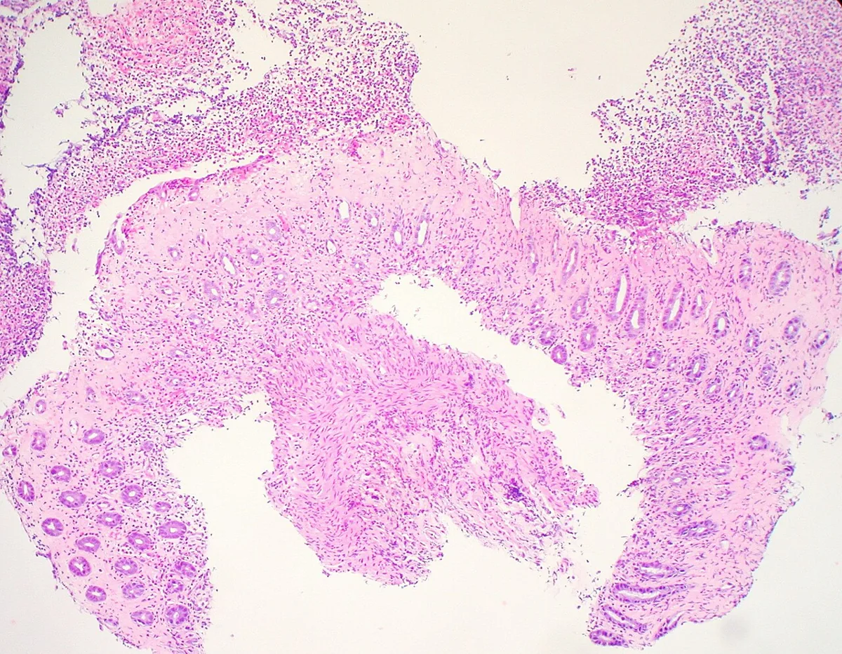 Ischemic colitis – Colonic biopsy (H&E): atrophic, withered crypts, hyalinised lamina propria and superficial necrosis in ischemic colitis