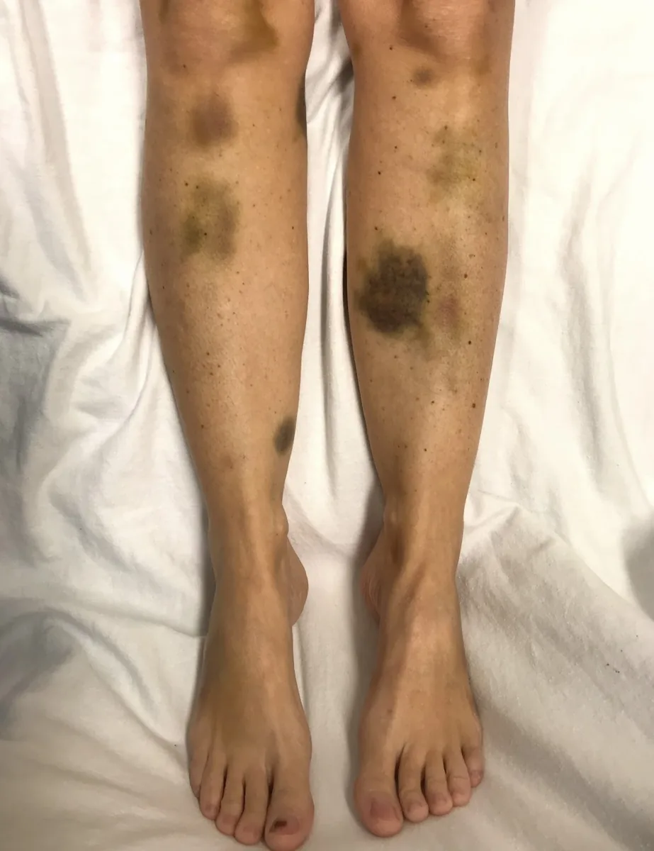 Immune thrombocytopenia (ITP) – clinical photo: Spontaneous large bruises (ecchymoses) and petechiae on both lower legs with critically low platelets