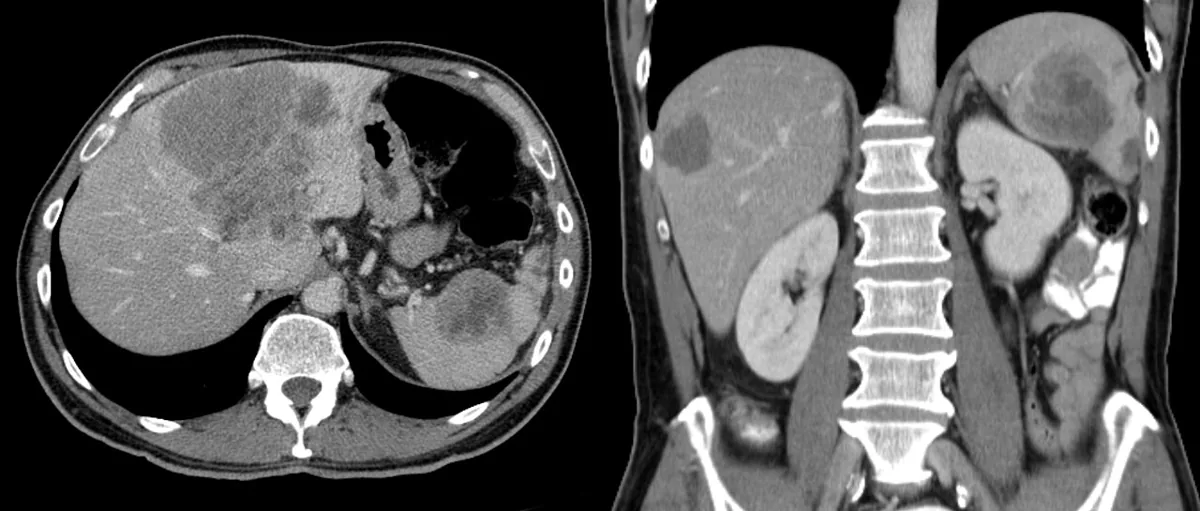 Colorectal cancer – CT axial and coronal: multiple hypodense liver and spleen metastases of a sigmoid adenocarcinoma