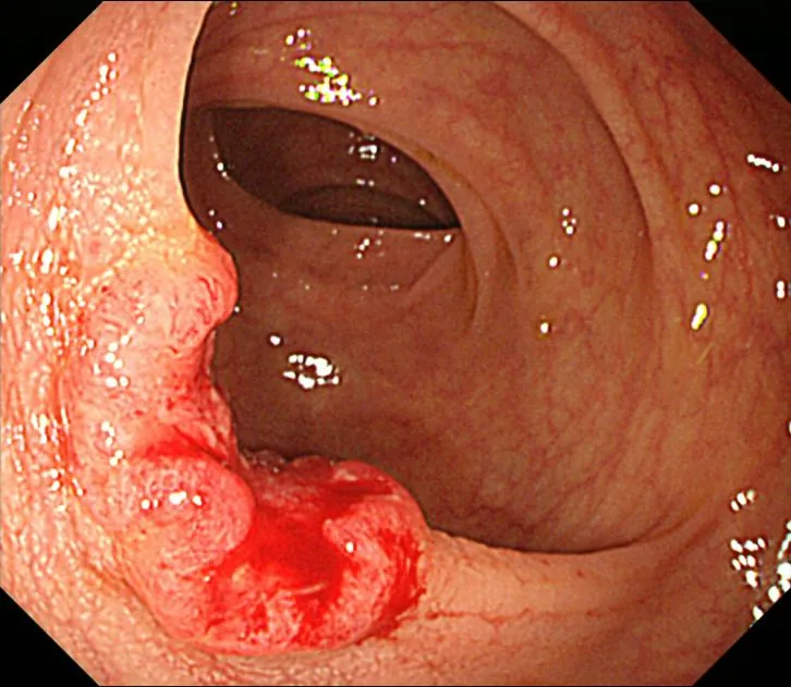 Colorectal cancer – Colonoscopy: nodular, friable mural tumor at the rectosigmoid junction (colon carcinoma)
