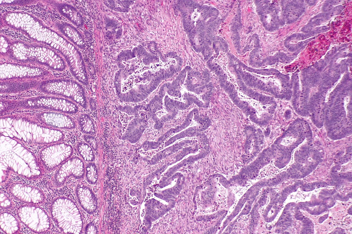 Colorectal cancer – Histology (H&E): colorectal adenocarcinoma with atypical, irregular glands (right) next to normal colonic mucosa (left)