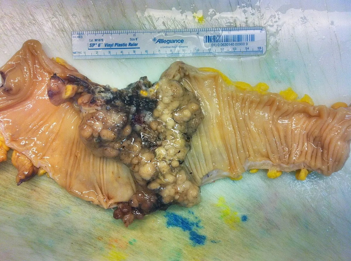 Colorectal cancer – gross specimen: Opened colon: large ulcerated, cauliflower-like carcinoma arising in an adenoma