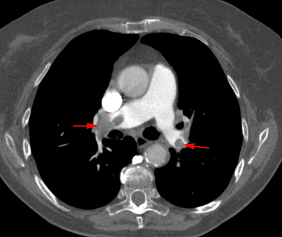Lungenembolie – CT-Pulmonalisangiographie: Kontrastmittelaussparungen (Emboli) in der rechten und linken Pulmonalarterie (Pfeile)