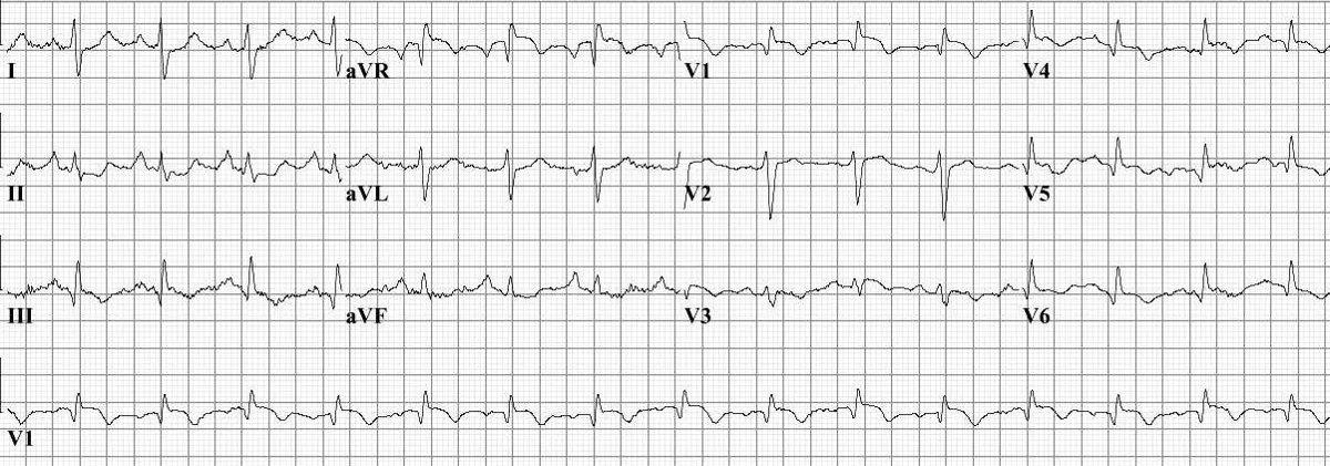 Lungenembolie – 12-Kanal-EKG bei Lungenembolie: tiefes S in I, Q-Zacke und negative T-Welle in III (SI-QIII-Typ), Frequenz um 100/min