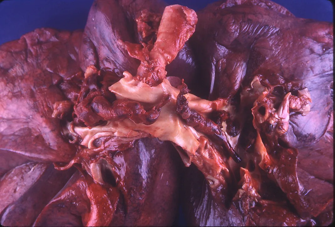 Lungenembolie – Makropräparat: Autopsiebefund: dunkelroter Thrombembolus, der sich über die Aufzweigung der Pulmonalarterie legt (reitender Embolus)