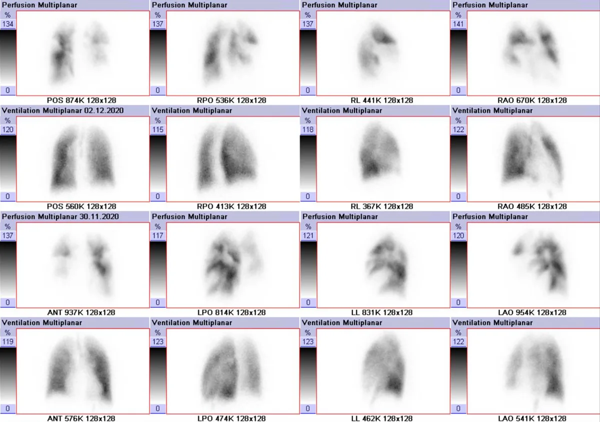 Lungenembolie – V/Q-Szintigraphie: segmentale Perfusionsdefekte bei unauffälliger Belüftung der Lunge (Mismatch)