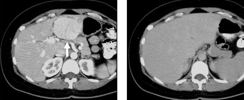 Benign liver tumors (hemangioma, FNH, adenoma) – CT in focal nodular hyperplasia: intense homogeneous late arterial enhancement (arrow), isodense to liver in the portal venous phase