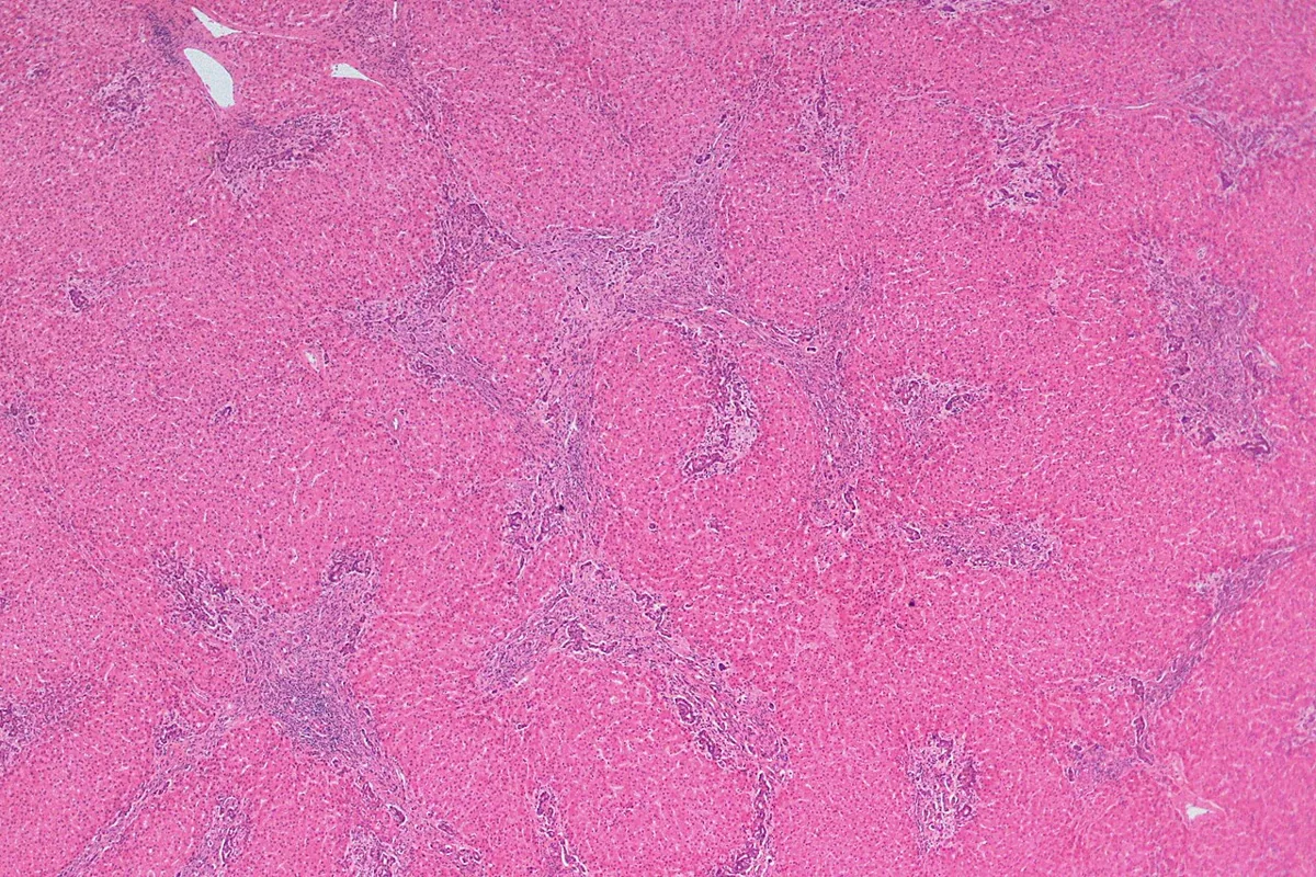 Benign liver tumors (hemangioma, FNH, adenoma) – Histology (H&E) of focal nodular hyperplasia: nodules of hepatocytes divided by fibrous septa with ductular proliferation