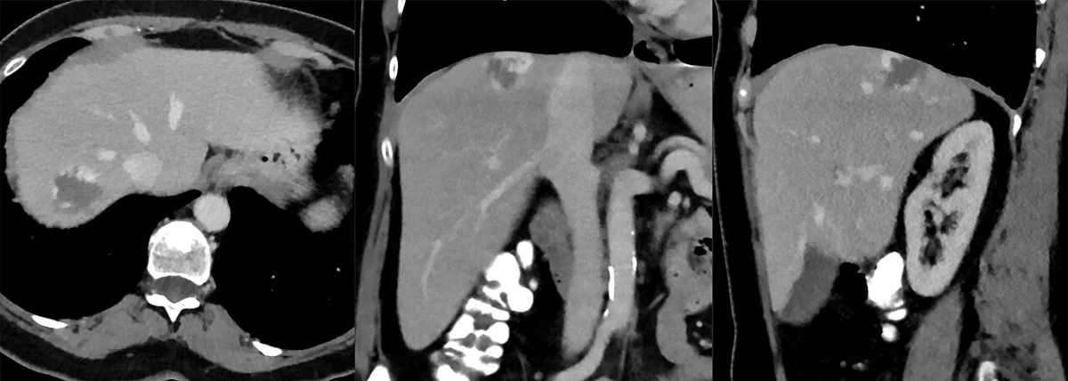 Benign liver tumors (hemangioma, FNH, adenoma) – Portal venous CT (axial, coronal, sagittal): typical liver hemangioma with peripheral, patchy-nodular contrast enhancement