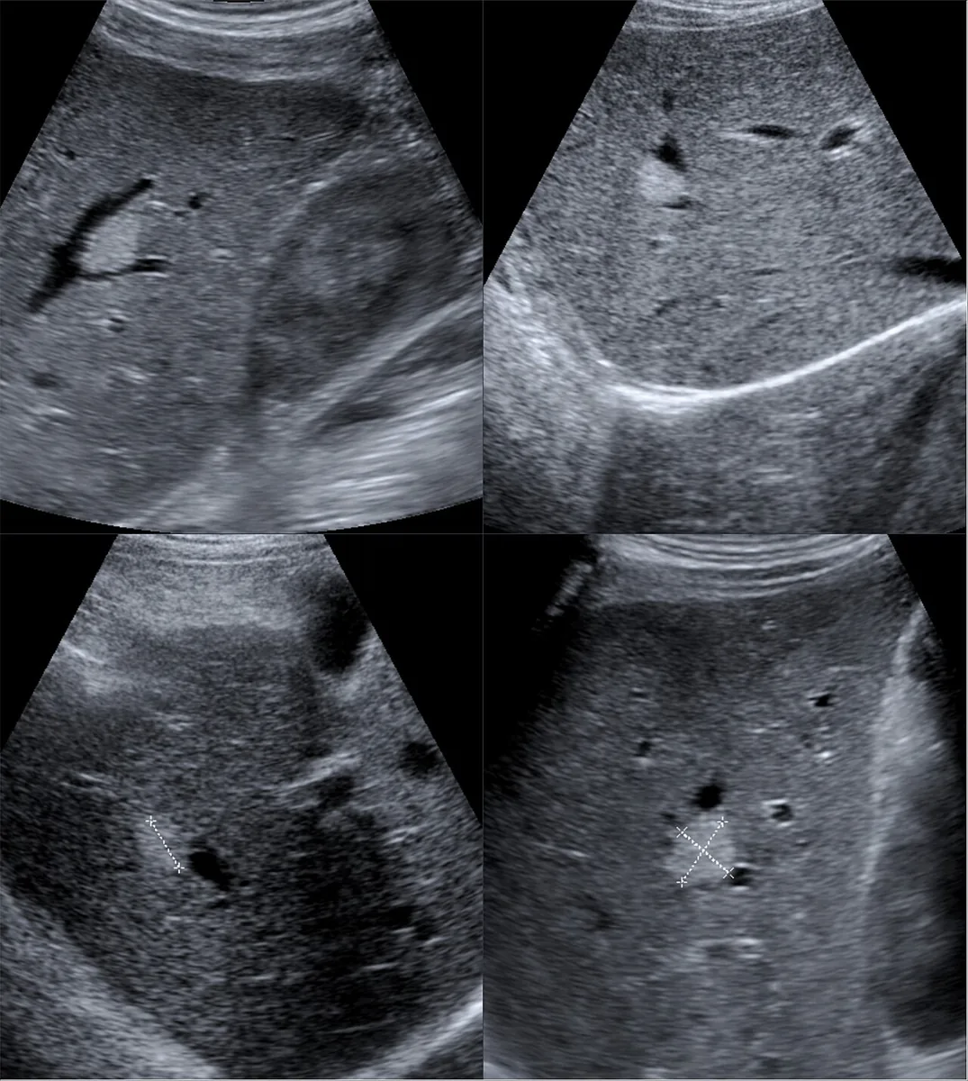 Benign liver tumors (hemangioma, FNH, adenoma) – Ultrasound: liver hemangiomas as hyperechoic, sharply demarcated round lesions