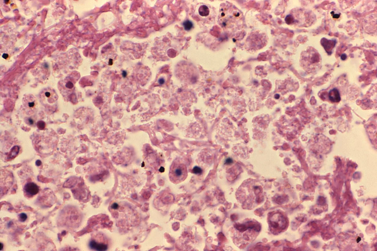 Legionnaires' disease – Histology (H&E) in fatal Legionnaires' disease: alveoli filled with an exudate of macrophages, cell debris and fibrin