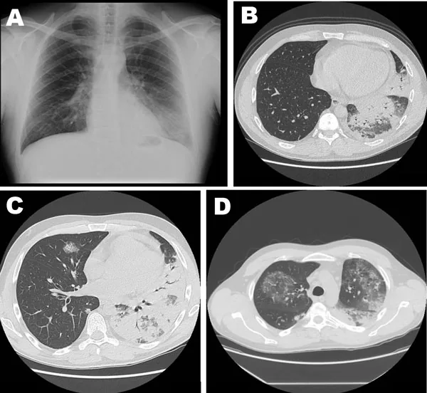 Legionnaires' disease – X-ray and CT in Legionella pneumonia: consolidation of the left lower lobe with air bronchograms, later patchy infiltrates in both upper lobes as well