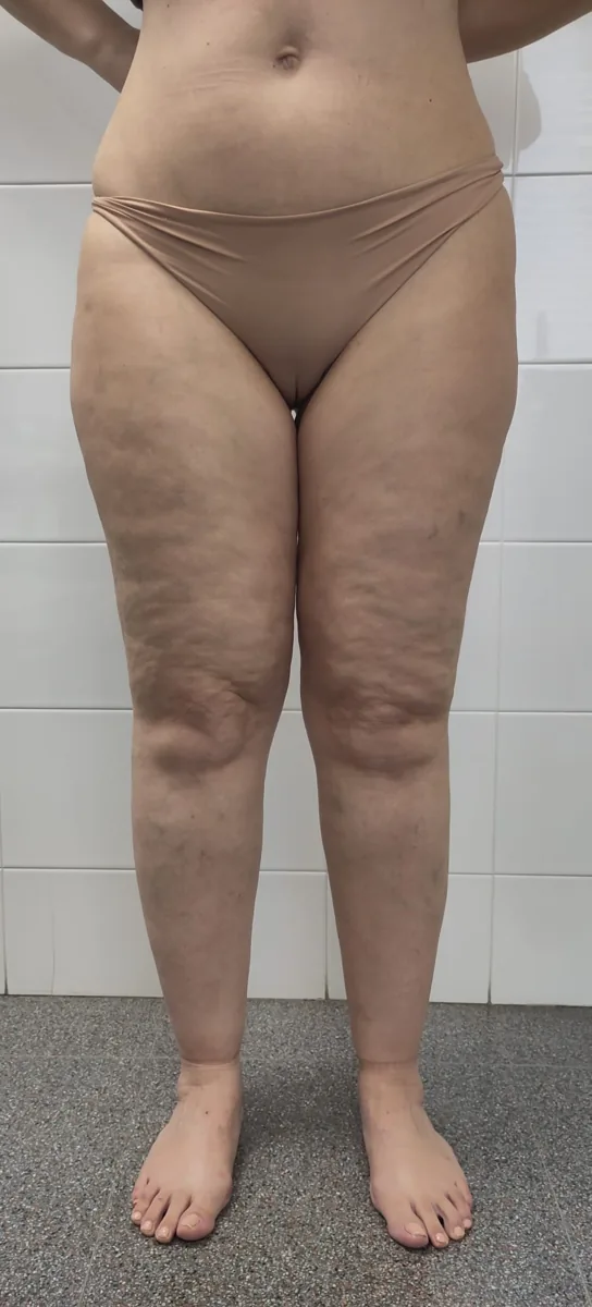 Lipödem – Bein, Fuß – klinisches Foto: Lipödem (Typ III): symmetrische Fettgewebsvermehrung an Ober- und Unterschenkeln mit Betonung der Knieinnenseiten, Füße ausgespart
