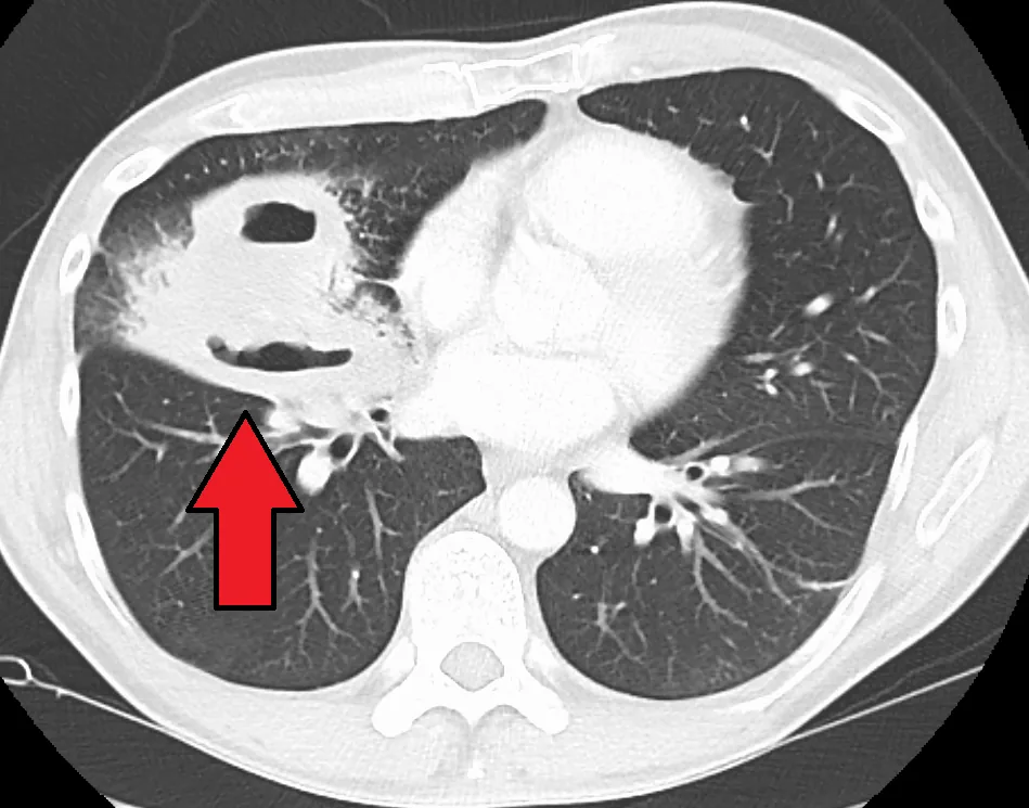 Lung abscess – Axial CT (lung window): thick-walled abscess cavity in the right middle lobe with an air-fluid level (arrow)