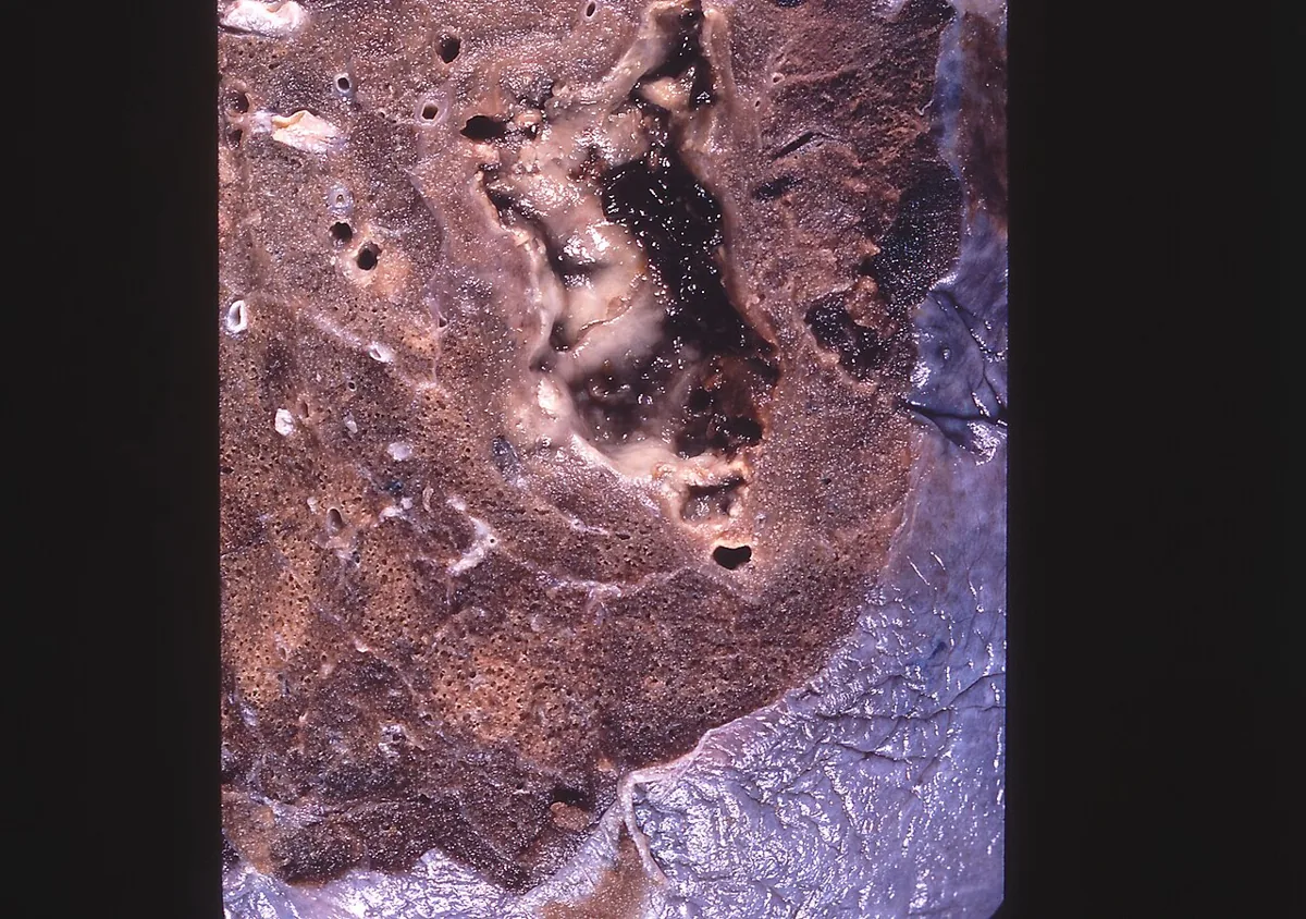 Lung abscess – Gross specimen: lung abscess as an irregular cavity with necrotic purulent contents and surrounding consolidation