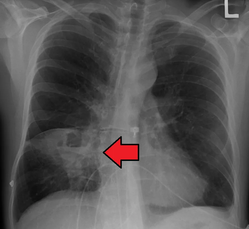 Lung abscess – Chest X-ray (PA): round cavitating lesion with an air-fluid level in the right lower zone (arrow)