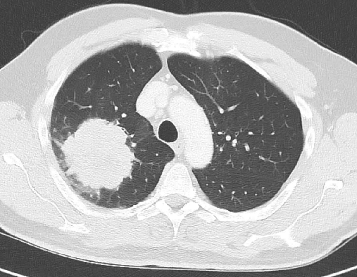 Lung cancer (bronchial carcinoma) – Axial CT (lung window): large, ill-defined tumor in the right upper lobe abutting the pleura (adenocarcinoma)