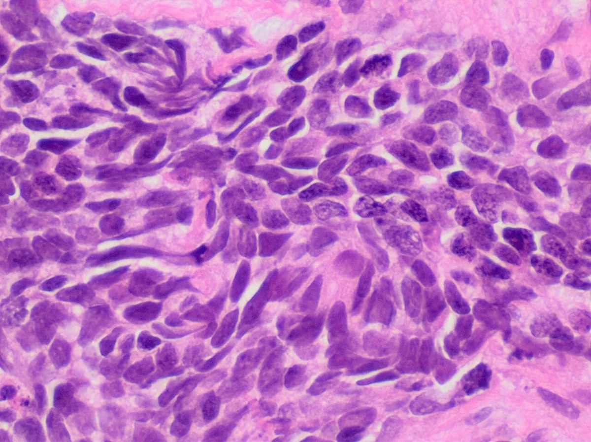 Lung cancer (bronchial carcinoma) – Histology (H&E): small cell carcinoma – densely packed cells with hyperchromatic, moulded nuclei and scant cytoplasm