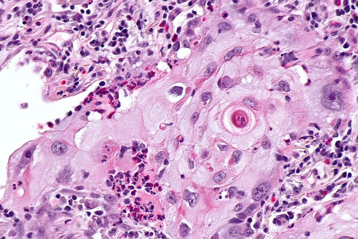 Lung cancer (bronchial carcinoma) – Histology (H&E): squamous cell lung carcinoma with atypical tumor cells and keratinisation