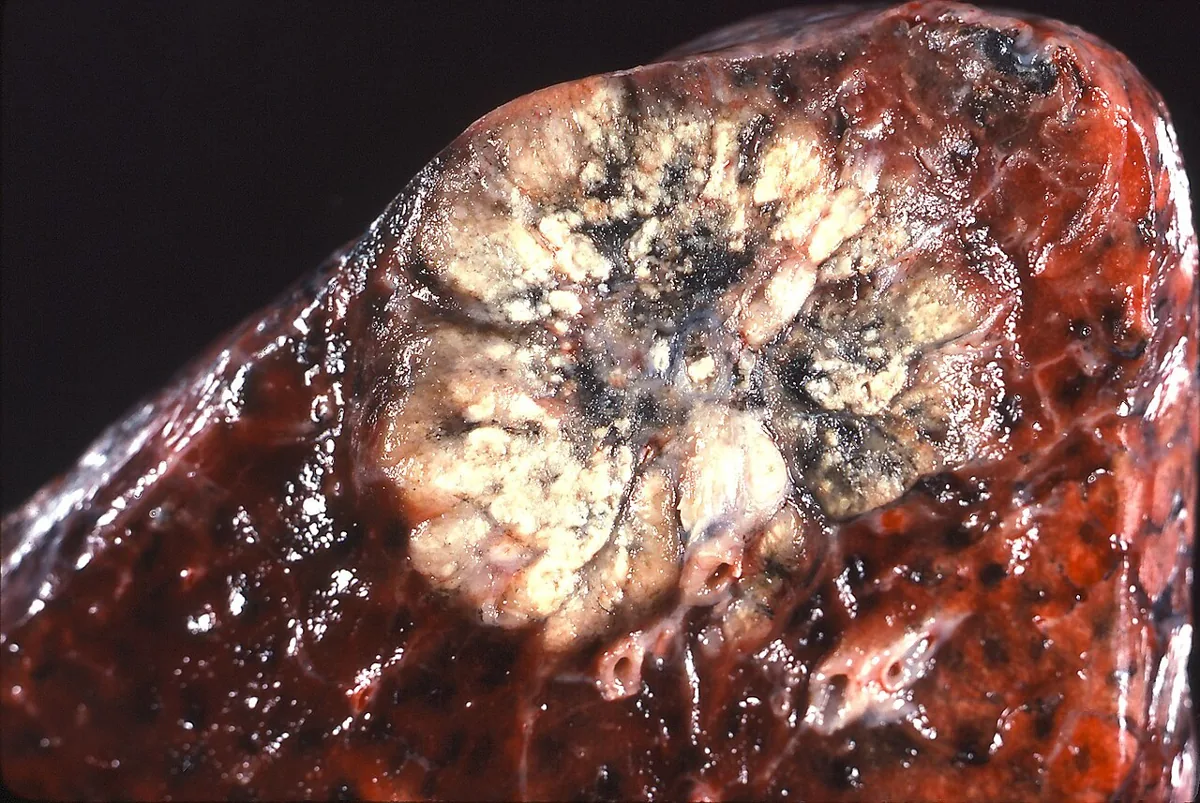 Lung cancer (bronchial carcinoma) – Gross specimen: peripheral adenocarcinoma as a grey-white nodule with central scarring and anthracotic pigment