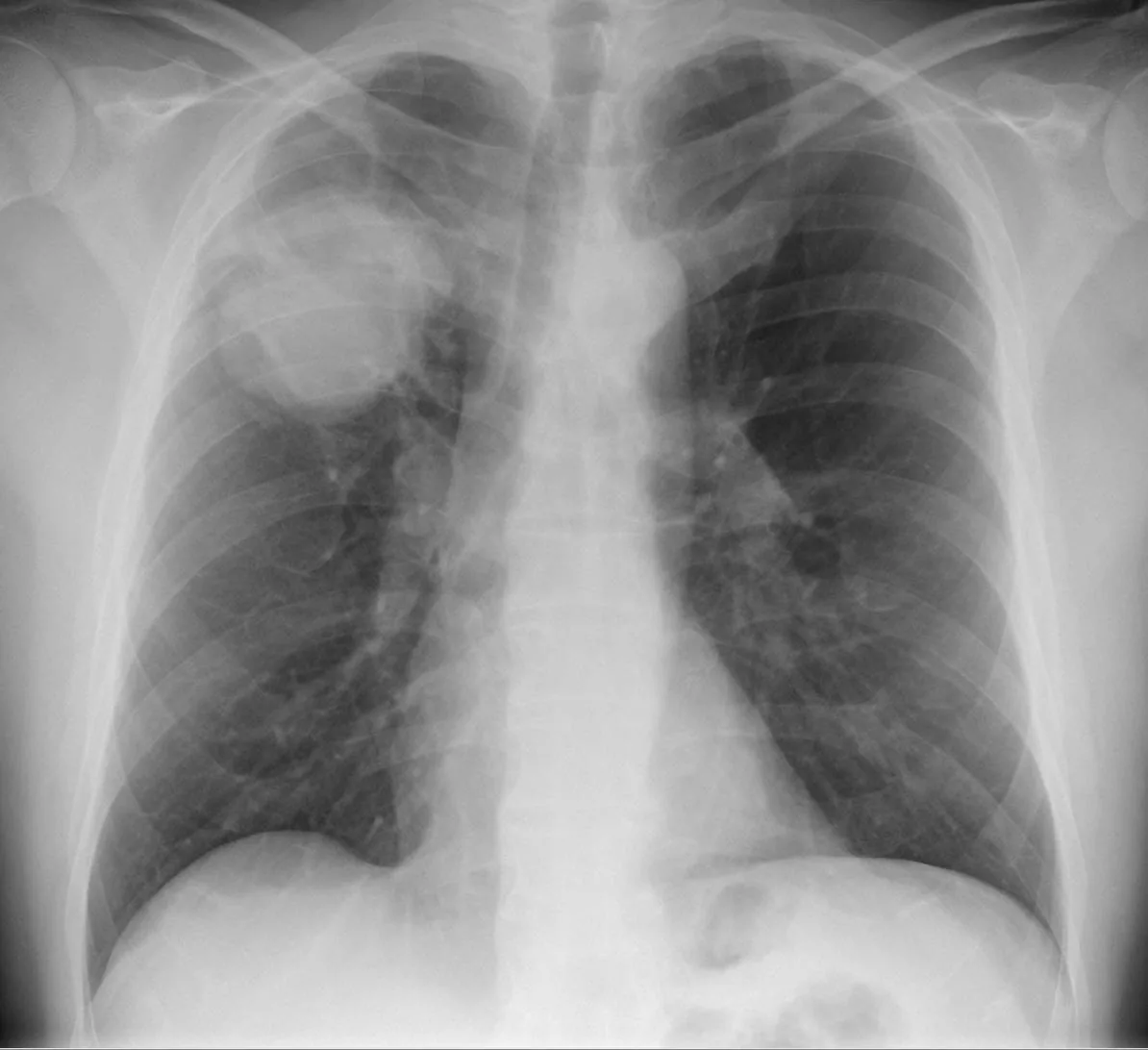 Lung cancer (bronchial carcinoma) – Chest X-ray (PA): round mass in the right upper zone (adenocarcinoma of the lung)