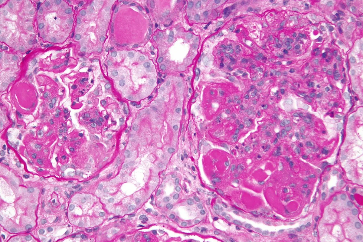 Lupus nephritis – Histology (PAS) in diffuse proliferative lupus nephritis: hypercellular glomeruli with wire-loop thickening and hyaline thrombi