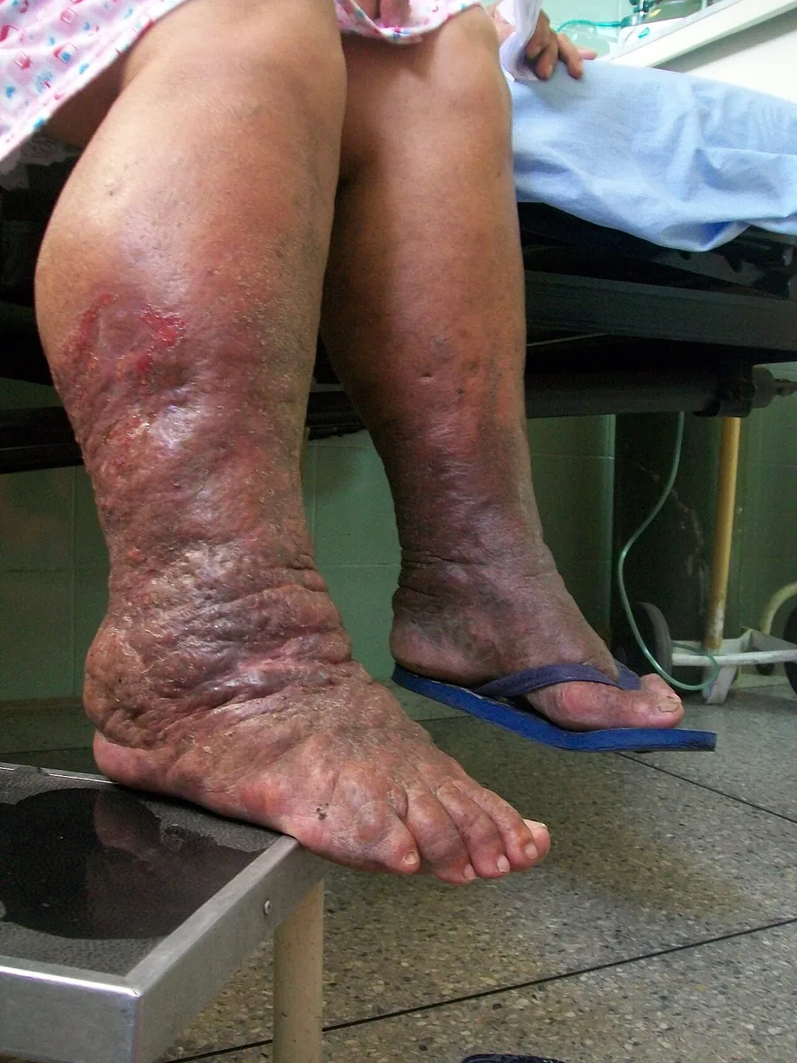 Lymphödem – Bein, Spätstadium – klinisches Foto: Fortgeschrittenes Lymphödem: massiv verdickter Unterschenkel mit verstärkten Hautfalten, Hyperkeratose und Papillomatose