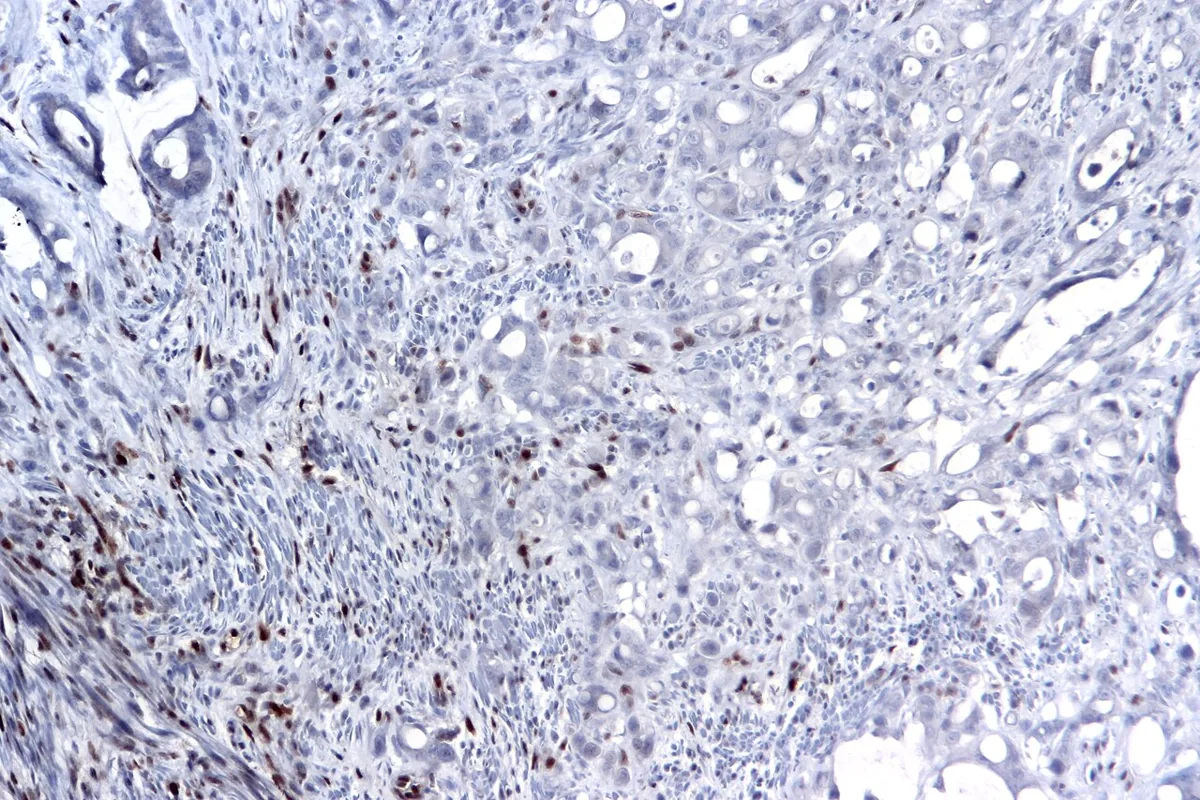 Lynch syndrome (HNPCC) – histology: MLH1 immunostain: loss of nuclear staining in tumor cells with retained staining in lymphocytes and stroma (MSI-high)