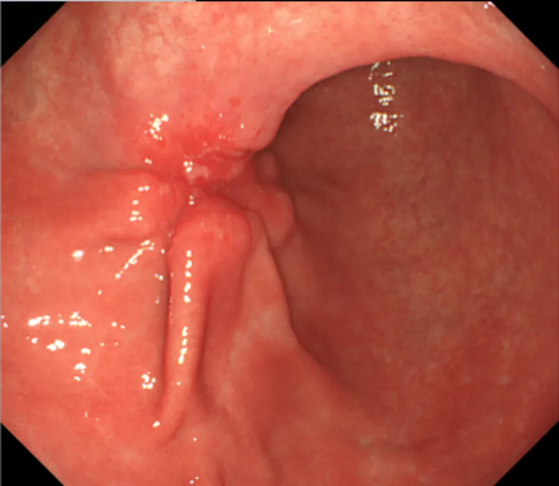 Gastric cancer – endoscopy: Gastroscopy: ulcerating tumor of the anterior gastric body wall with raised margin and converging folds (Borrmann type 3)