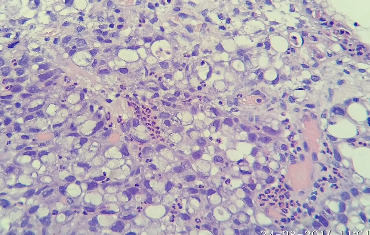 Gastric cancer – Histology (H&E): diffusely infiltrating poorly cohesive carcinoma with signet-ring cells